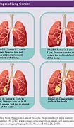 Image result for Stage 4 Metastatic Lung Adenocarcinoma
