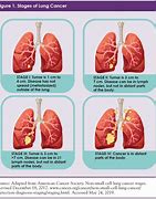 Image result for Small Cell Lung Cancer vs Non Small Cell Lung