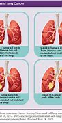 Image result for Stage 4 Adenocarcinoma Lung Cancer