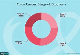 Image result for Stage 4 Metastatic Colon Cancer