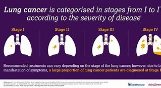 Image result for Stage 4 Lung Cancer Fluid around Heart