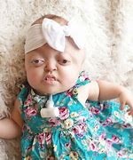 Image result for Pfeiffer Syndrome Hand