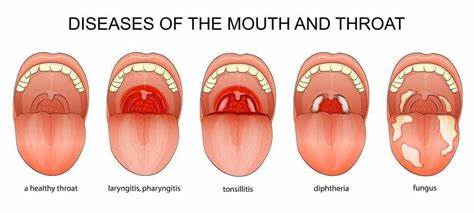 Canadian Health Care Gives Information about Pharyngitis - Canadian ...