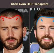 Image result for Chris Pratt Hair Transplant