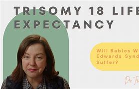 Image result for Trisomy 18 Life Expectancy