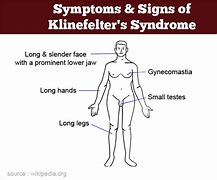 Image result for Person with Klinefelter
