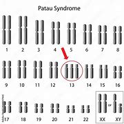Image result for Patau Syndrome Phenotype