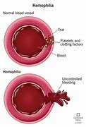 Image result for Hemophilia A Proteins