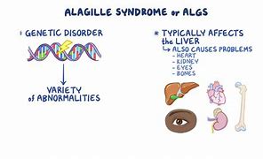 Image result for Alagille Syndrome Life Expectancy