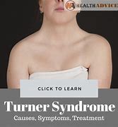 Image result for Developments of Turner Syndrome for Girls