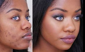 Image result for Types of Face Blemishes
