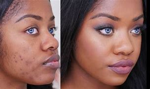Image result for Face with Blemishes