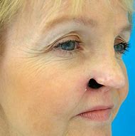 Image result for Prosthetic Nose