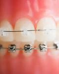 Image result for Types of Clear Braces