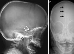 Image result for Hurler Syndrome X-ray