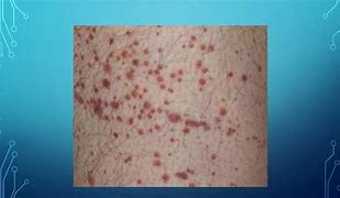 Image result for Idiopathic Thrombocytopenic Purpura System Disorder Template