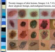 Image result for Untreated Stage 4 Melanoma