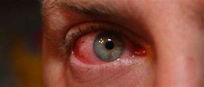 Image result for Scratched EyeBall Treatment