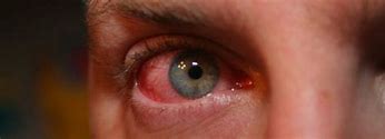 Image result for Scratched EyeBall