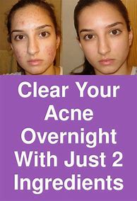 Image result for Get Rid of Acne Overnight