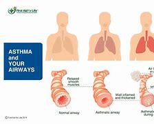 Image result for Asthma Older Adult