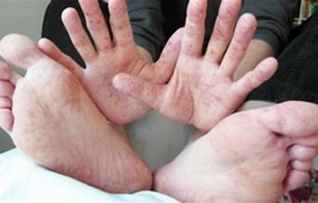 Résultat d’images pour Maladie des mains, des pieds et de la bouche