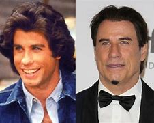 Image result for John Travolta Hair Transplant Before After
