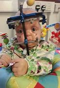 Image result for Pfeiffer Syndrome After Surgery