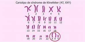 Image result for Klinefelter Syndrome Karyotype 47 XXY