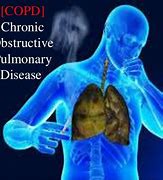 Image result for Chronic Obstructive Pulmonary Disease