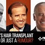 Image result for Biden Hair Transplant