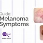 Image result for Signs of Melanoma