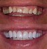 Image result for Teeth Filed Before Veneers