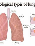 Image result for Types of Lung Cancer and Prognosis