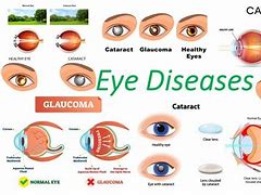 Image result for Medical Eye Conditions