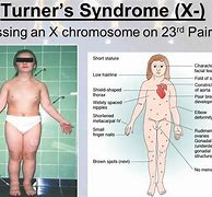 Image result for Social Difficulties with Turner Syndrome