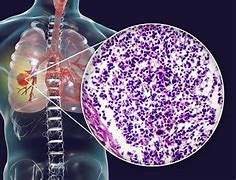 Image result for Combined Small Cell Lung Cancer