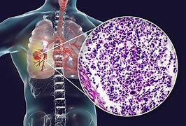 Image result for Radiation for Small Cell Lung Cancer