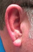 Image result for Ear Lobe Crease Sign