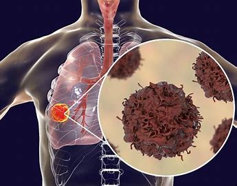 Image result for Medical Illustrations of Non-small Cell Lung Cancer