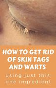 Image result for Skin Tag Removal Patch