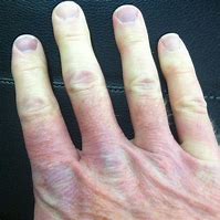 Image result for Syndrome De Raynaud