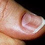 Image result for Small Dents in Hand