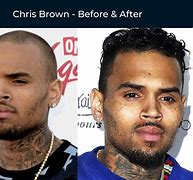 Image result for Chris Brown Hair Transplant