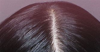 Image result for healthy scalp