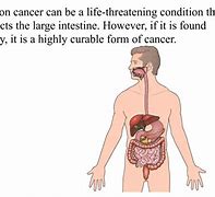 Image result for Processed food cancer