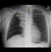 Image result for Small Cell Lung Cancer CXR