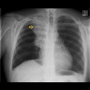 Image result for Small Cell Lung Cancer Location