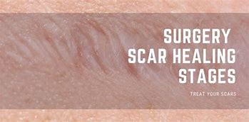 Image result for Surgical Scar Healing