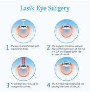Image result for Lasik Surgery Procedure